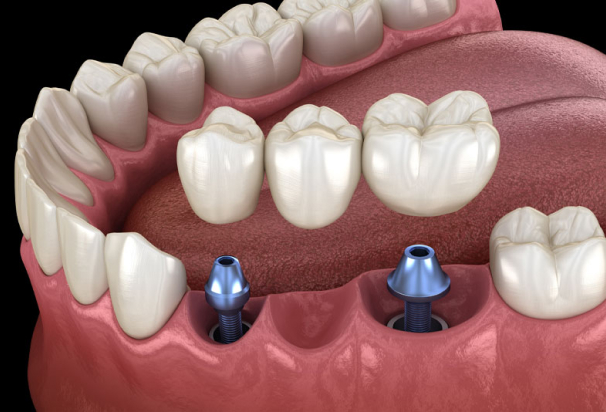 dental implant bridger 3d model