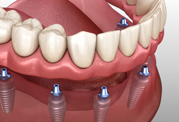 full mouth dental implants 3d model