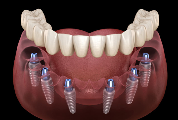 full mouth dental implants 3d model