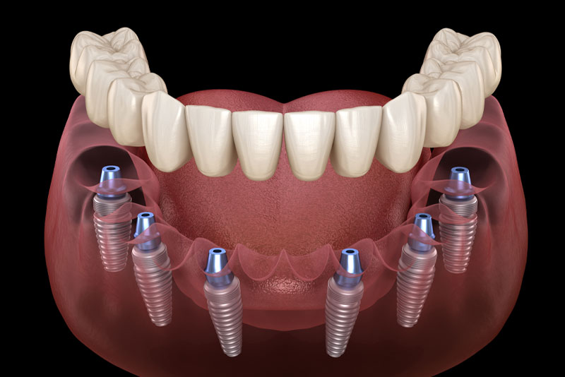full arch dental implants 3d model