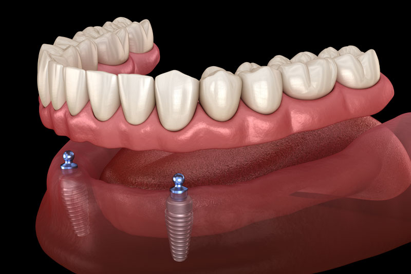 implants supported dentures 3d model