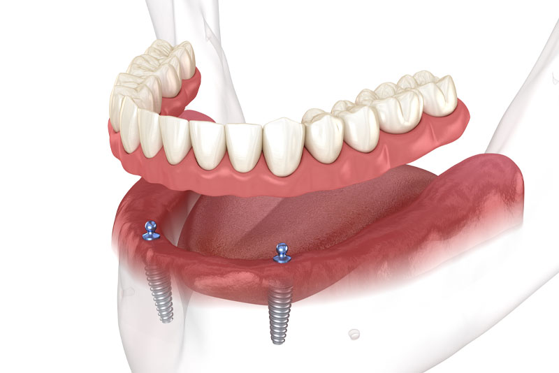 implant supported dentures model