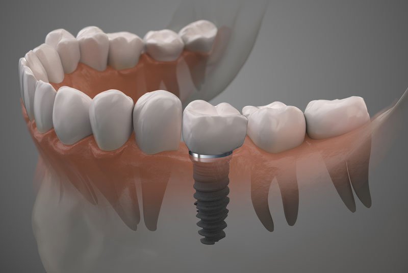 single dental implant model