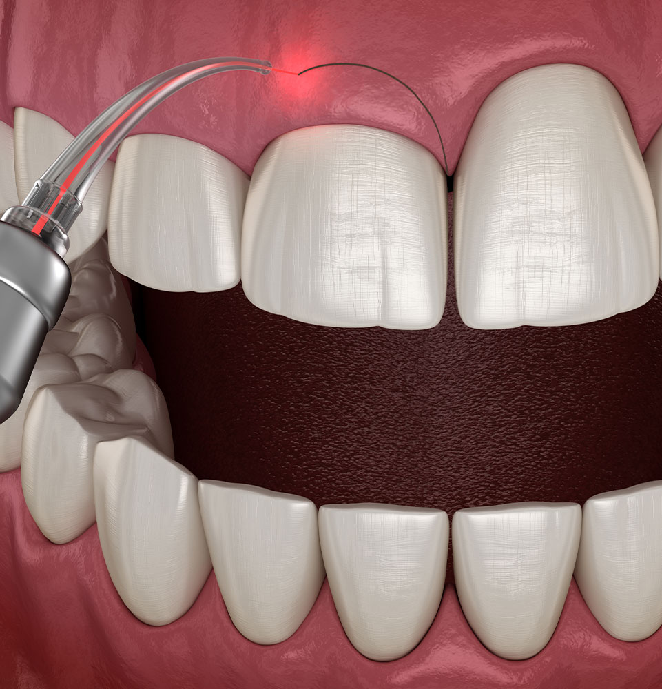 dental laser 3d model of crown lengthening