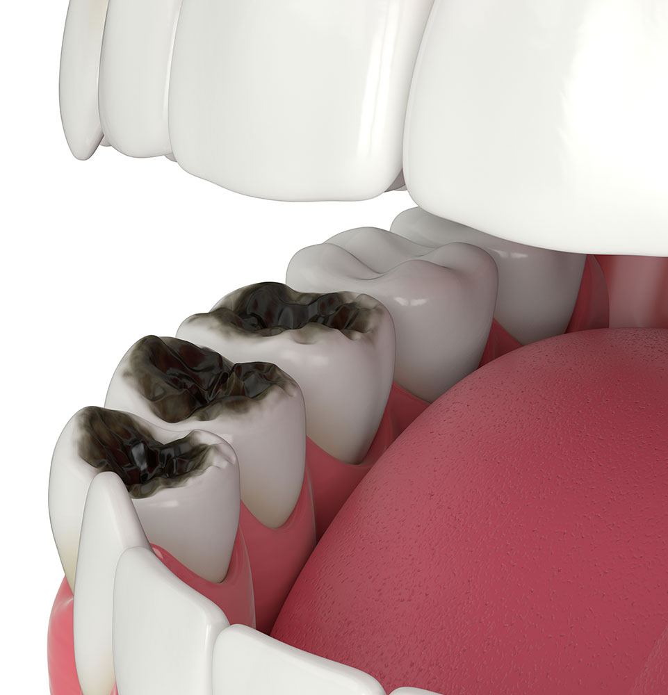 3d model of decayed teeth