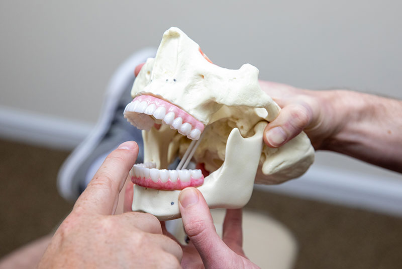 full arch dental implants model