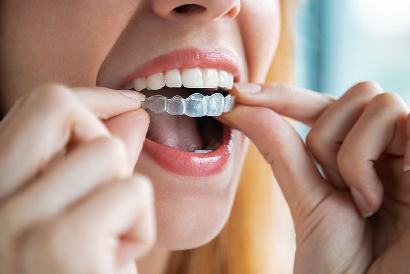 patient holding clear aligners